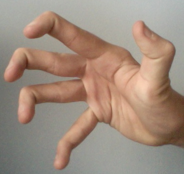 Hypermobile_fingers_and_thumb.jpg
